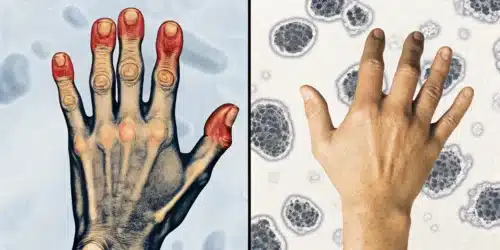 Best Strains for Arthritis